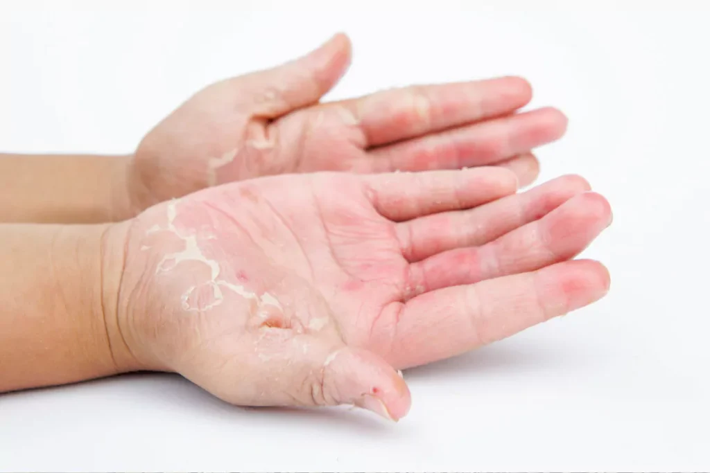 dry hands contact fungal infection 
organic ginger root Help to fight fungal infection