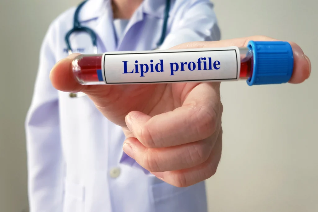 dr show of lipid test profile